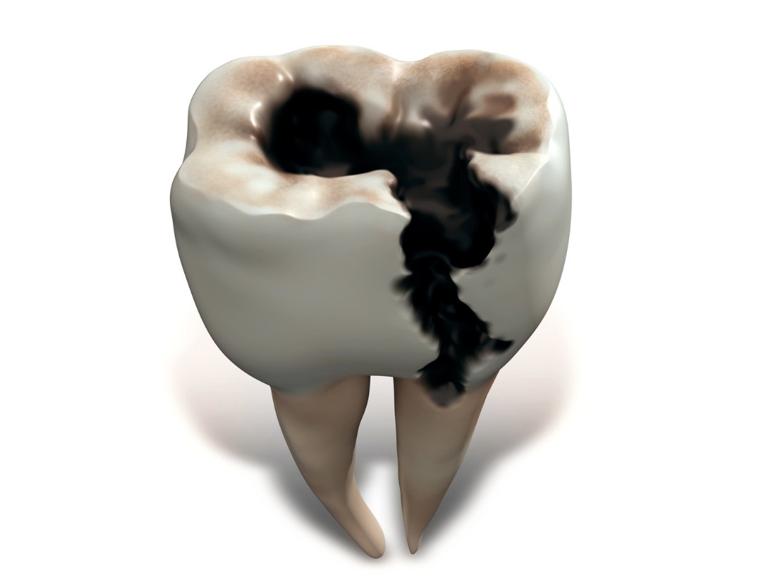 Dental Caries: Prevention and Care