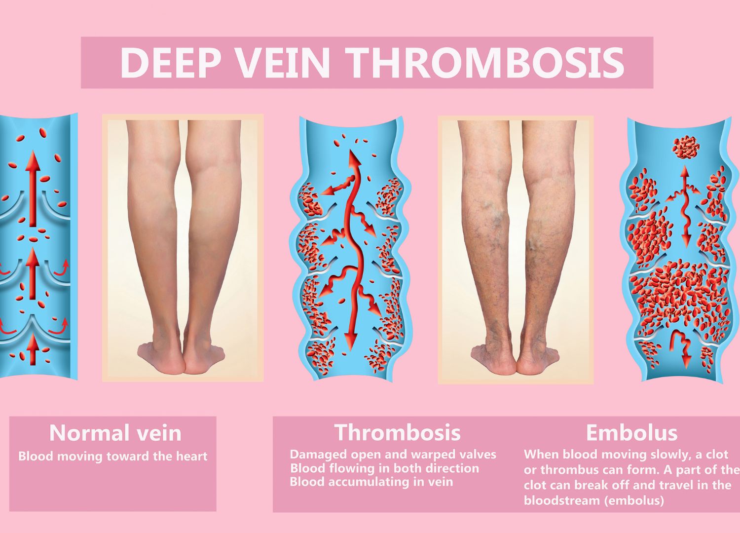 Deep Vein Thrombosis: Dangerous blood clot