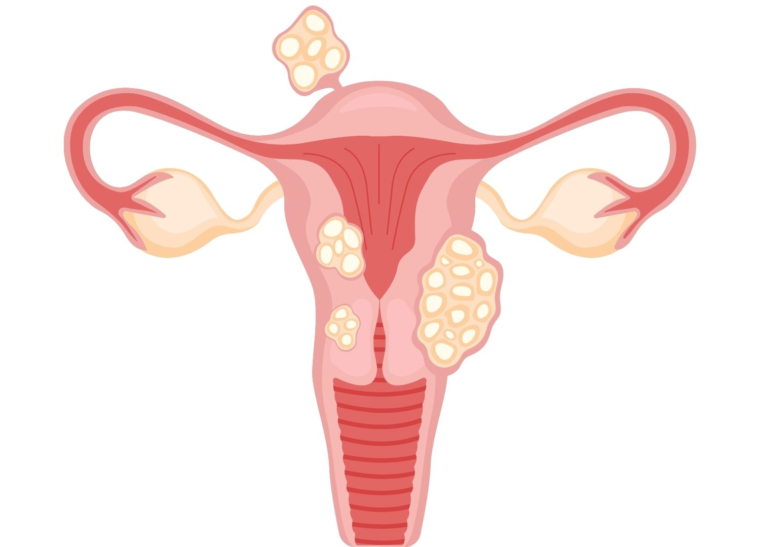 "Cervical cancer: Risk factors,  causes and treatment (Pidgin)"