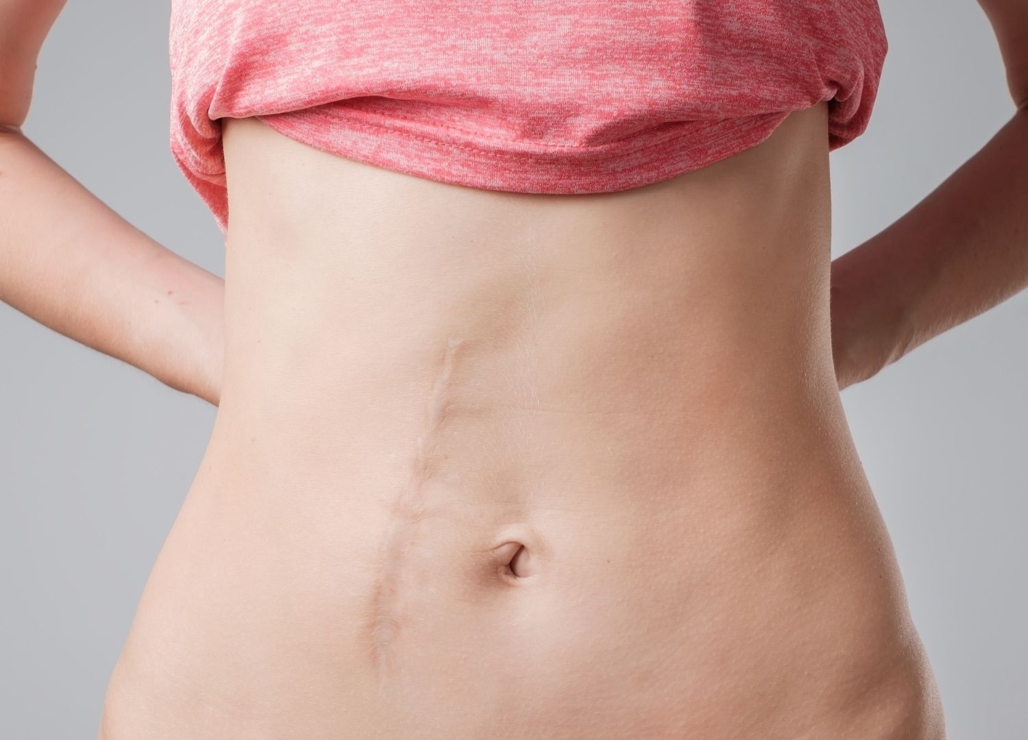 What to expect after an abdominal surgery