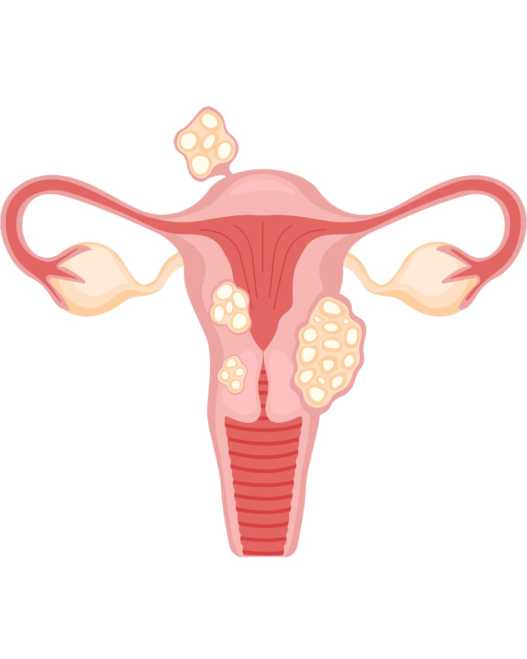 How Do Fibroids Affect Pregnancy and Fertility?