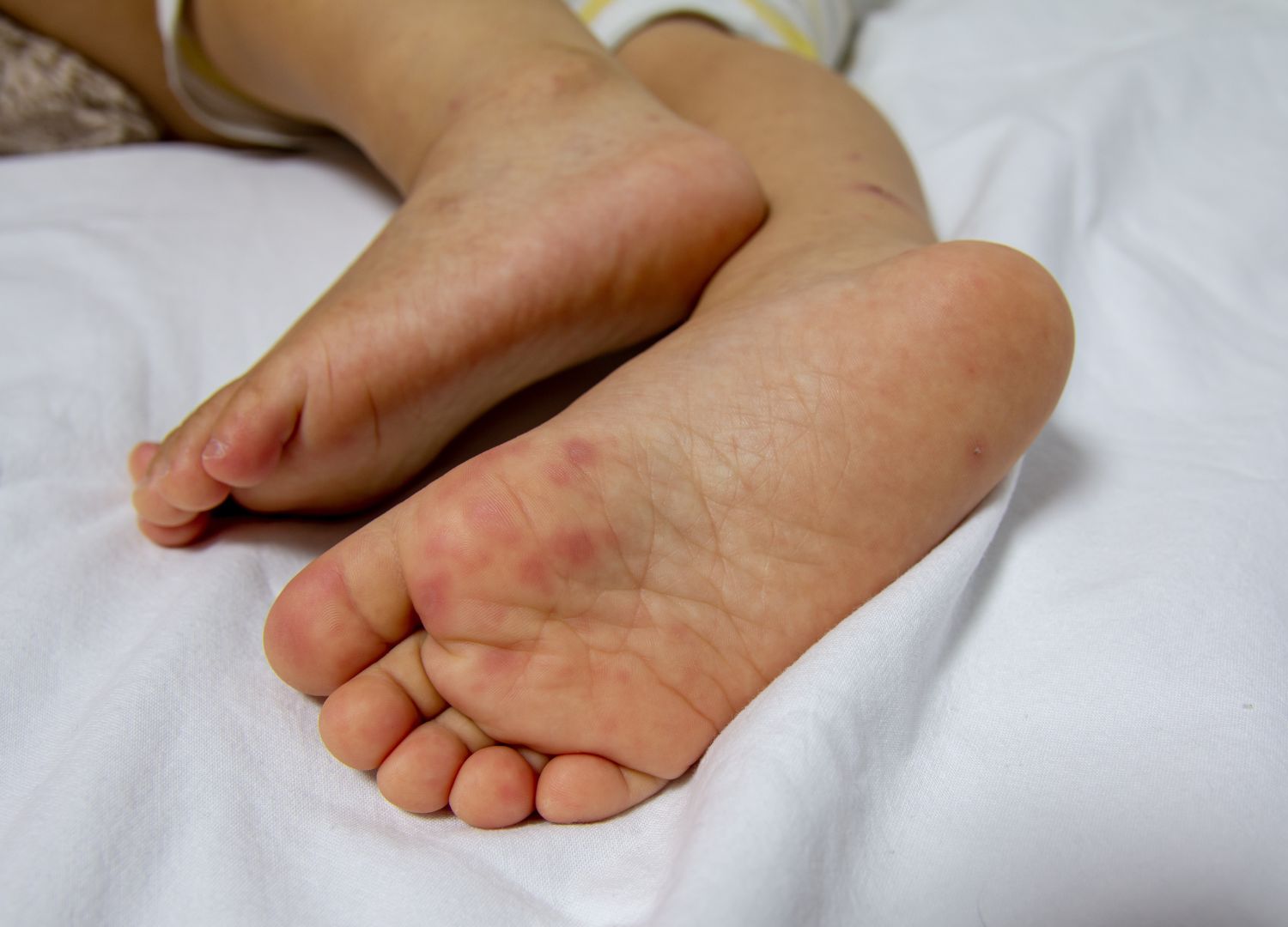 Hand,Foot and Mouth Disease