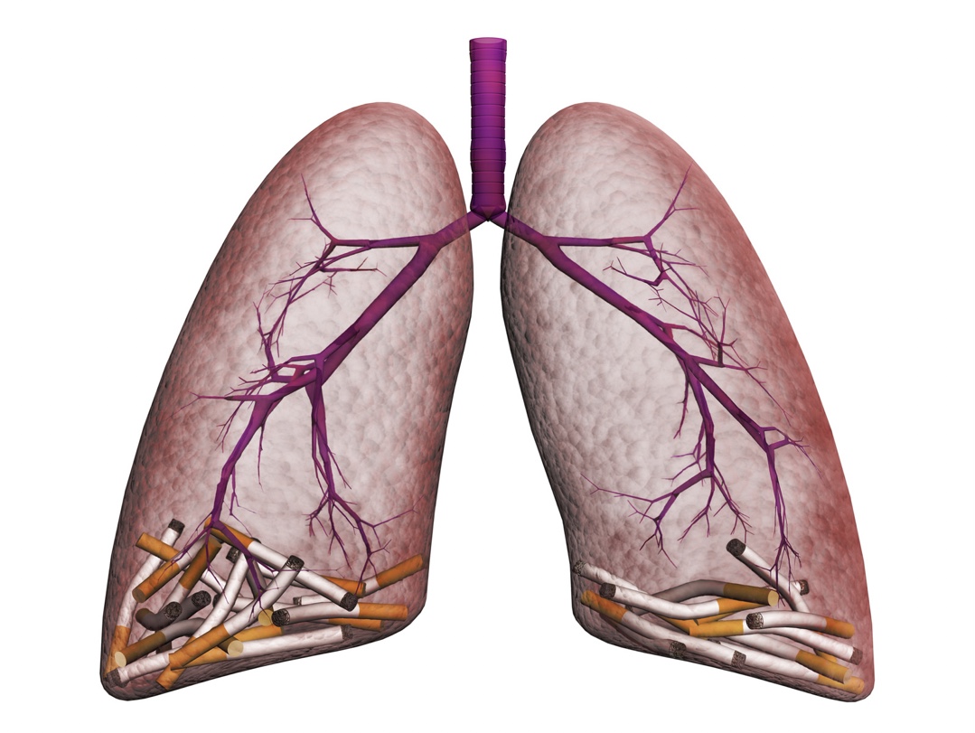 Smoker’s Lungs: Risk Factors and Symptoms