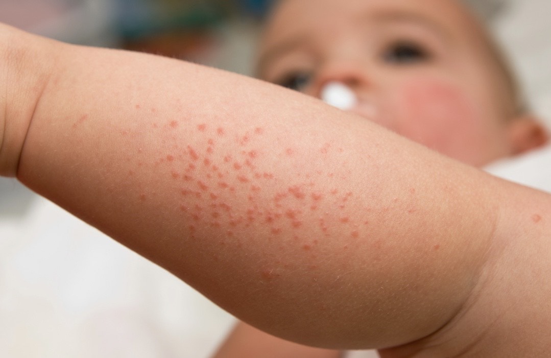 Are My Baby's Rashes Normal?