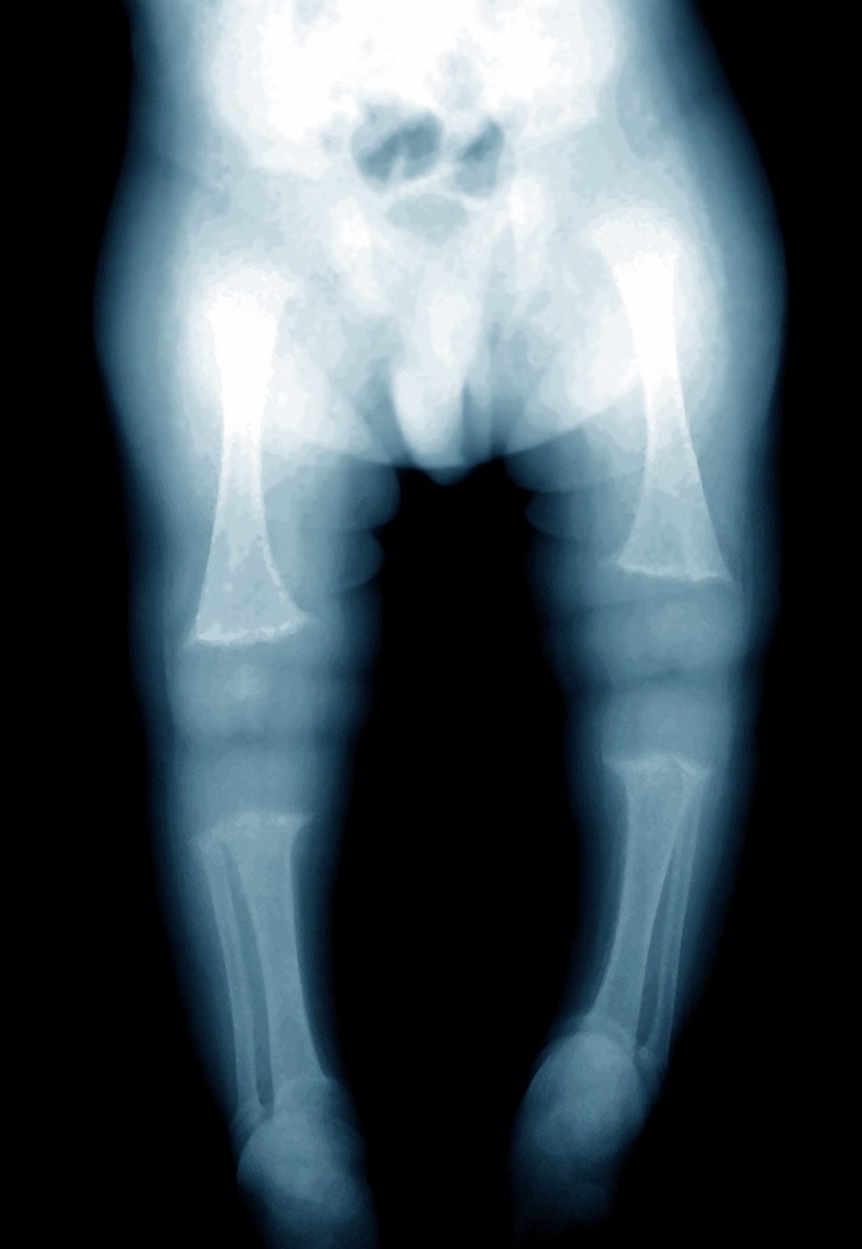 Rickets: My Child's Bones are Not Growing Well