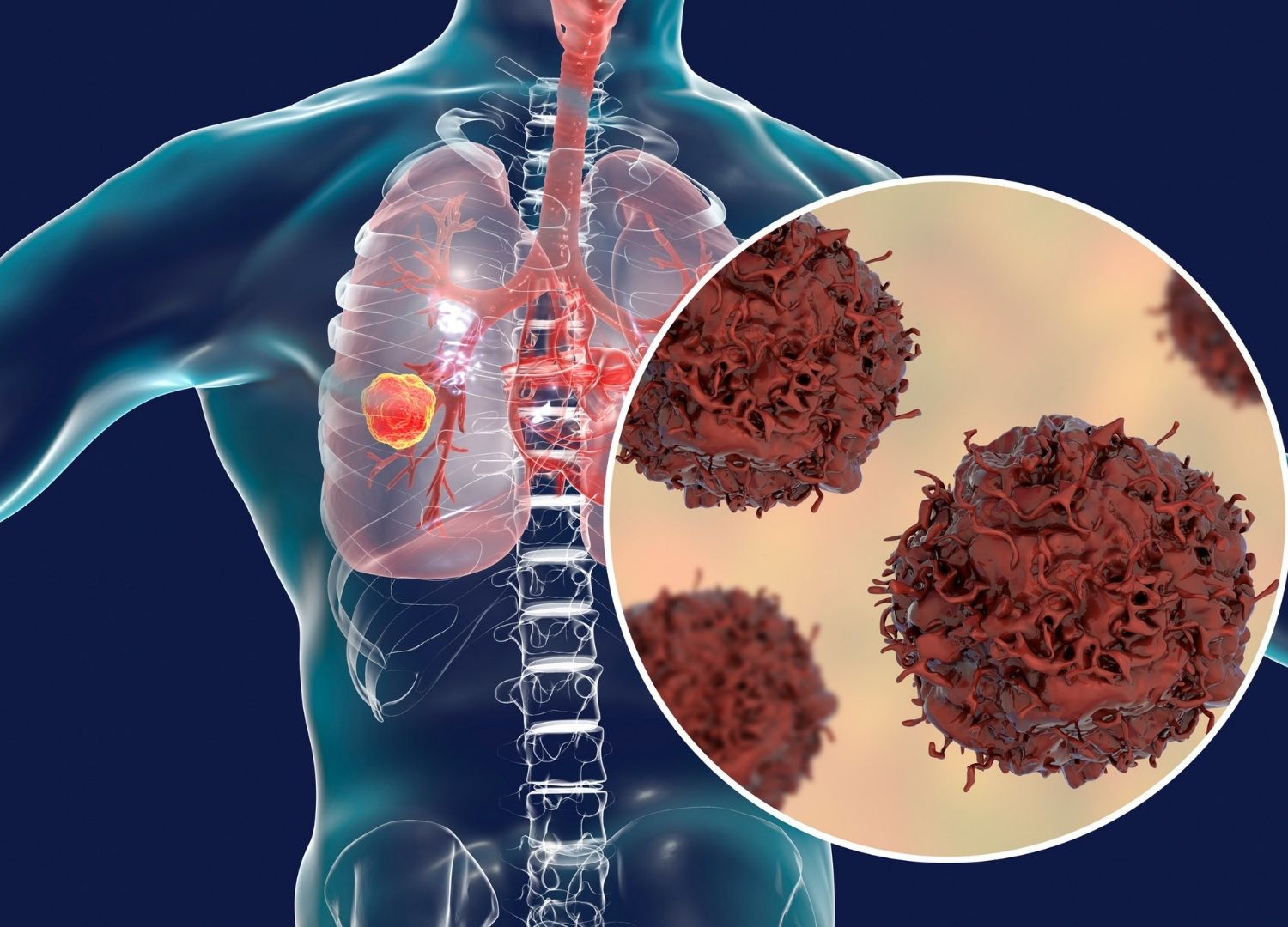 Lung cancer: Causes and treatment