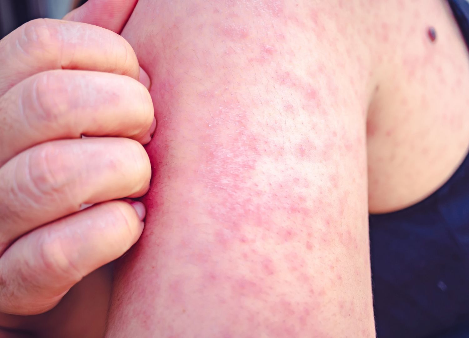 Do I have scabies?