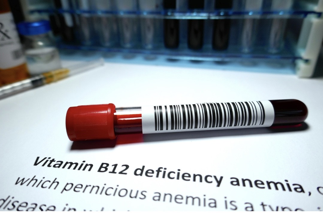 Vitamin B12 Deficiency