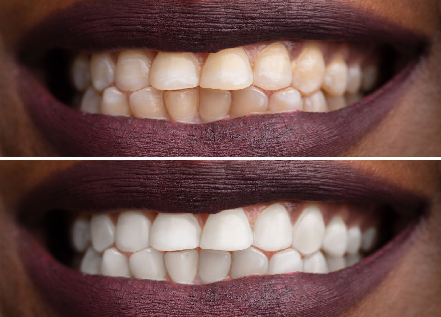 " 7 Things you should know about  teeth whitening (pidgin)"