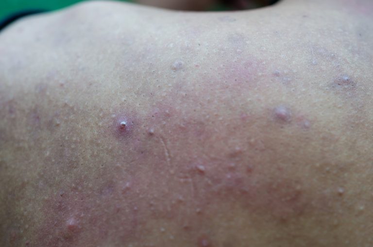 asian-teen-boy-inflammatory-acne-on-the-back_t20_LlxyQY-768x509