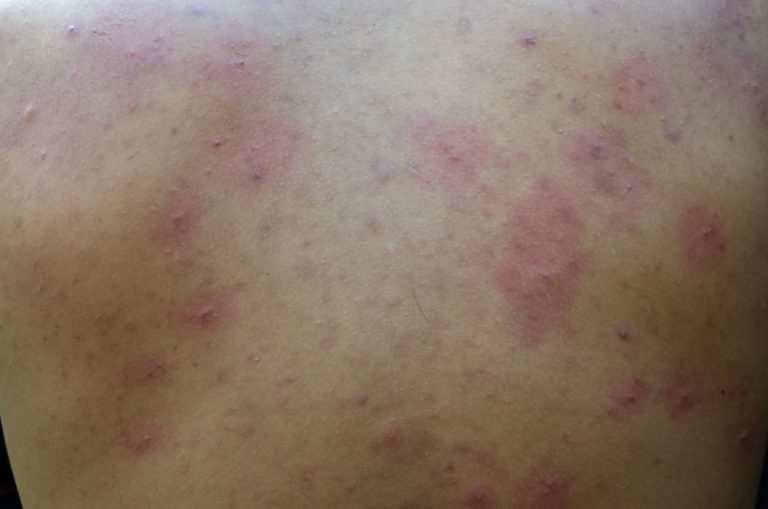 asian-teen-boy-inflammatory-acne-on-the-back_t20_mLKevn-1-768x509