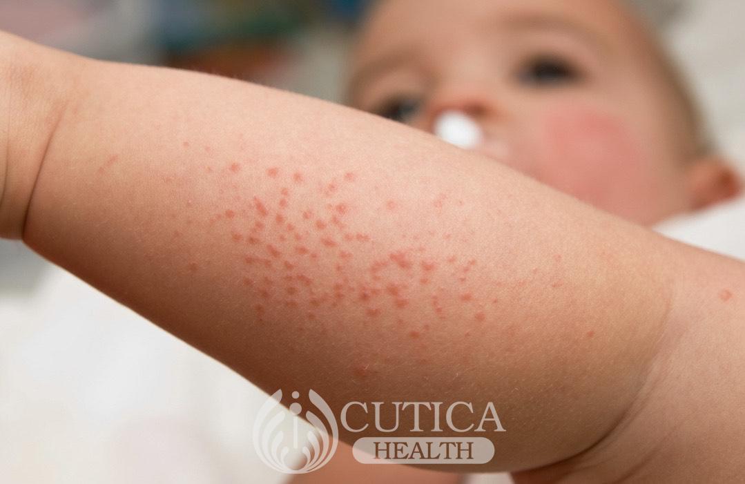 Are My Baby's Rashes Normal?