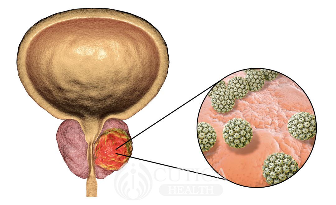 Prostate Cancer: What to Know