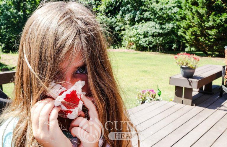 Reasons why your child may nosebleed, and what to do about it