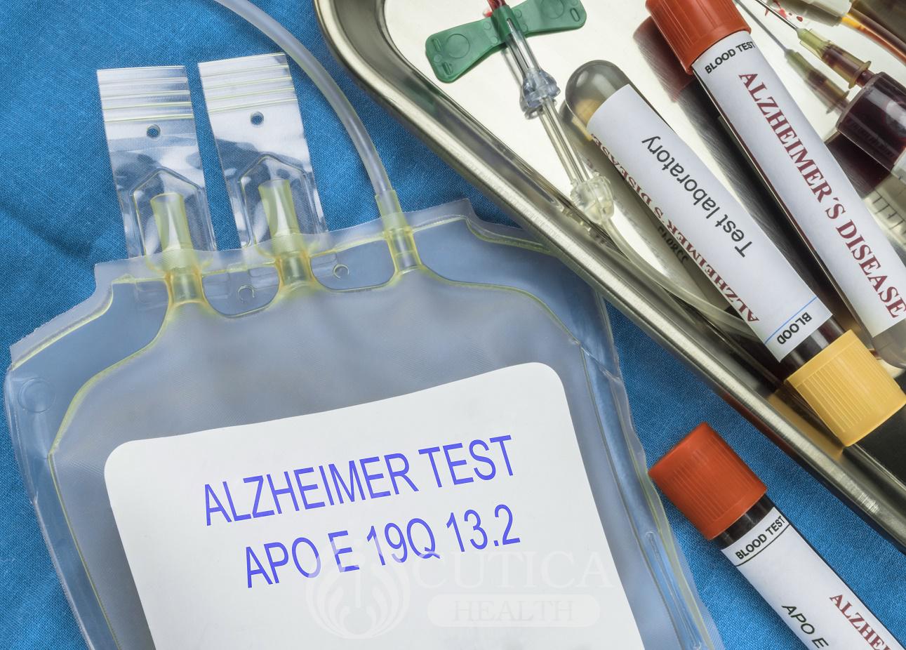 A potential way to treat Alzheimer’s disease discovered