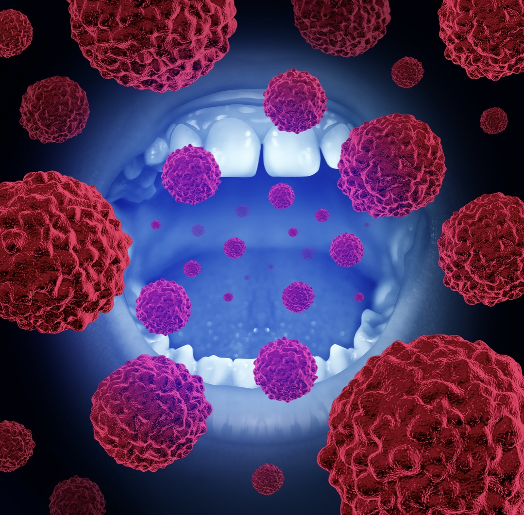 Oral Cancer: Be Mindful of these Risk Factors