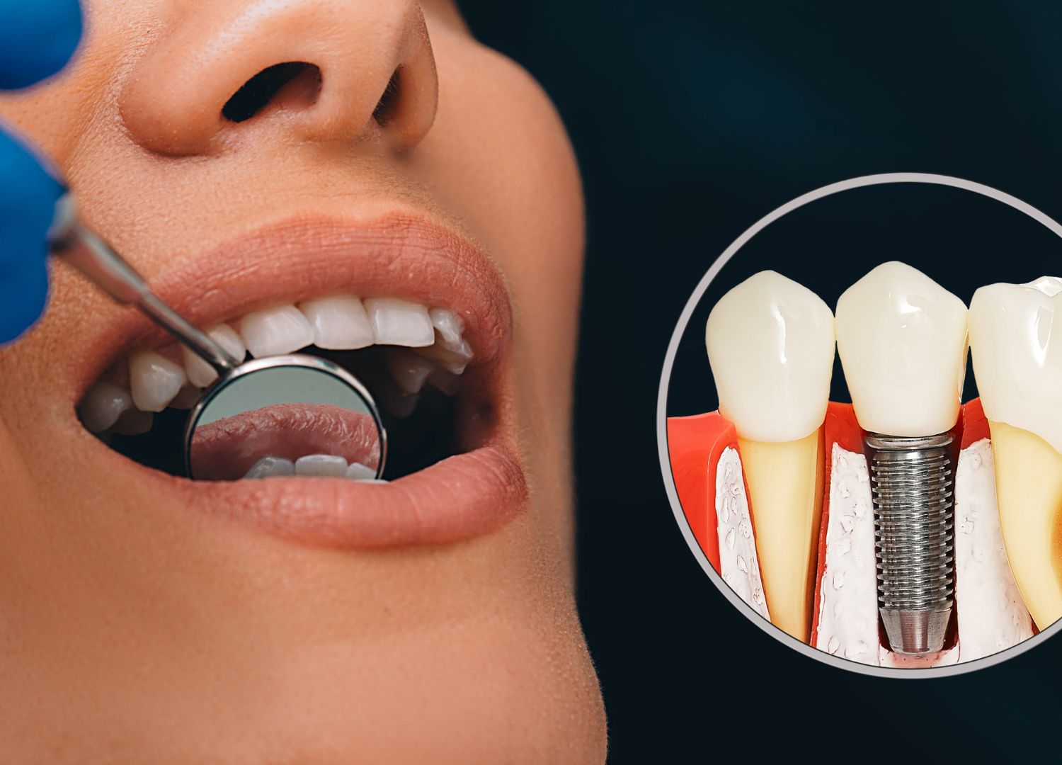 Dental Implants Or Dentures 2
