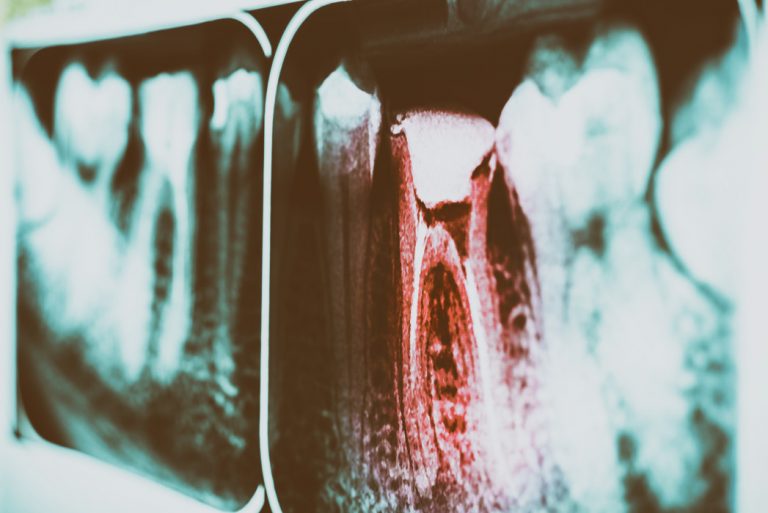 pain-of-tooth-decay-on-teeth-x-ray_t20_nerQwg-768x513