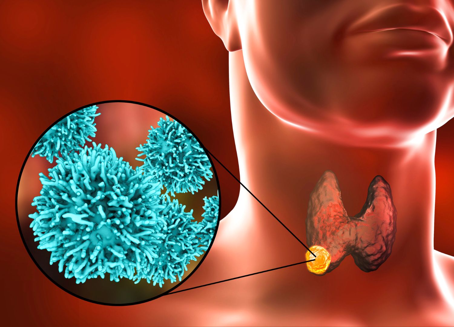 "Throat Cancers: Causes and  Treatments"
