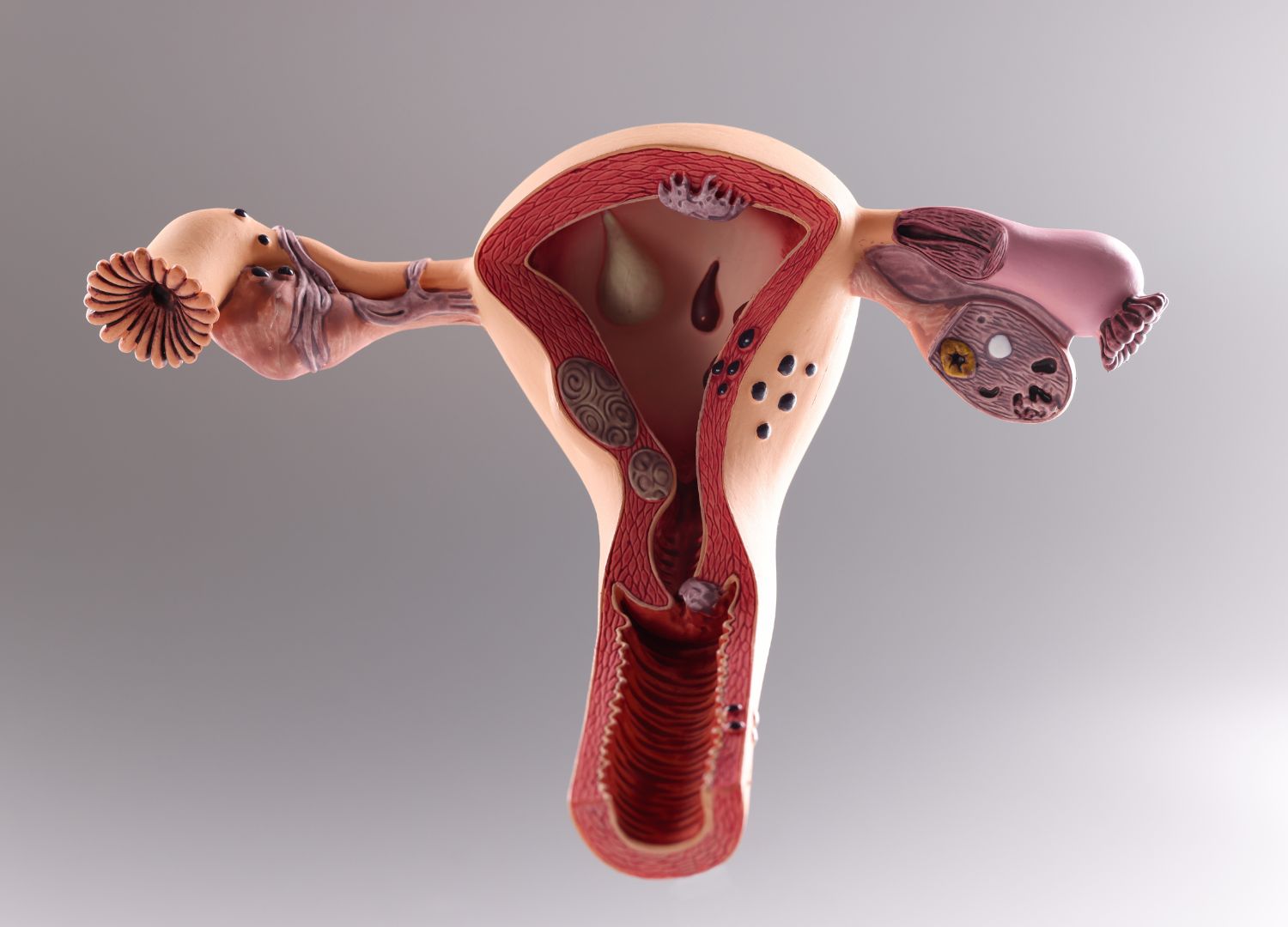 Understanding Cervical Cancer 18-01-2023 (2)