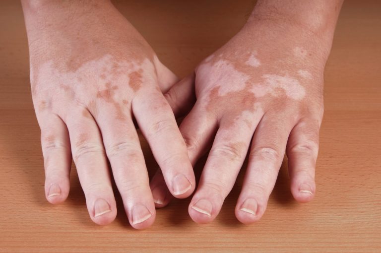 vitiligo-is-a-medical-condition-causing-depigmentation-of-patches-of-skin-vitiligo-pigment_t20_1n4NRY-768x510