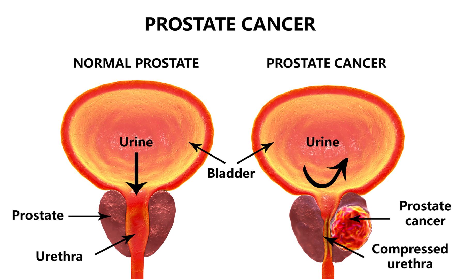 "What to know about prostate cancer  (Pidgin)"