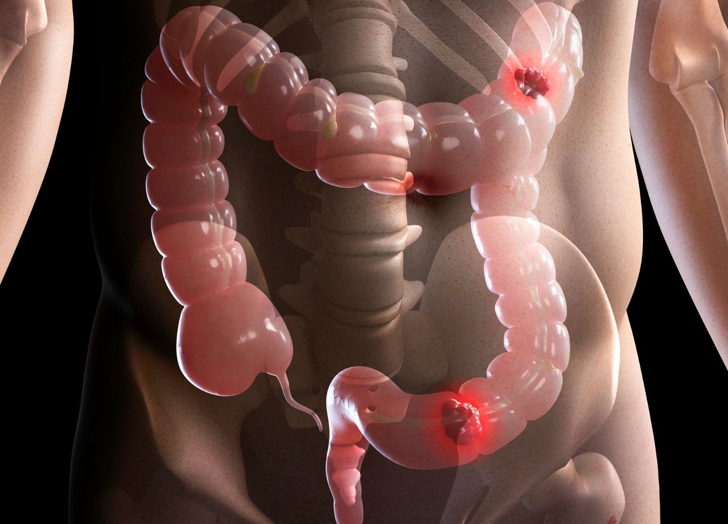 "What you should know about colon  cancer"